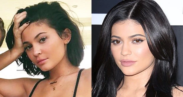 Kylie Jenner Dissolved Filler: The Beauty Trend Inspiring a Return to Natural Looks