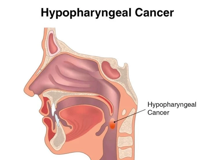 Market Insights into Hypopharyngeal Cancer Treatment: An In-depth Study