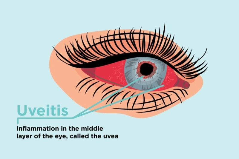 Understanding Uveitis: Causes, Symptoms, and Treatment