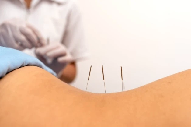 Benefits of Dry Needling Therapy and How It Works