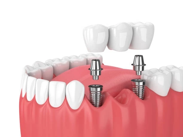 7 Advantages of Dental Implants Over Dentures and Bridges
