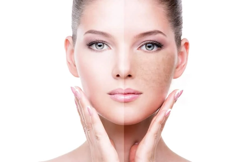 Reveal Your Glowing Skin with the Right Pigmentation Treatment