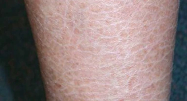 Global Fish Skin Disease Market Is Estimated To Witness High Growth Owing To Increasing Awareness Regarding Fish Health