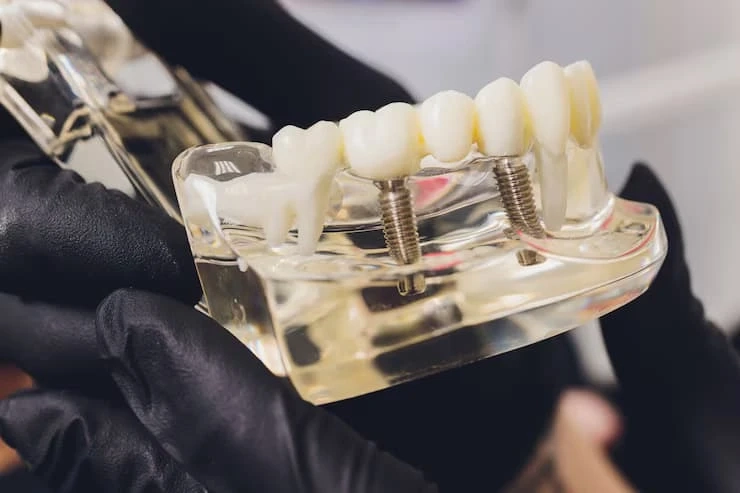 A Comprehensive Guide to Dental Implants in Burton: Restoring Smiles and Confidence