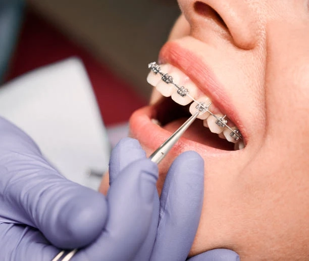 Modern Smiles Made Simple: Advancements in Braces in Alpharetta, GA