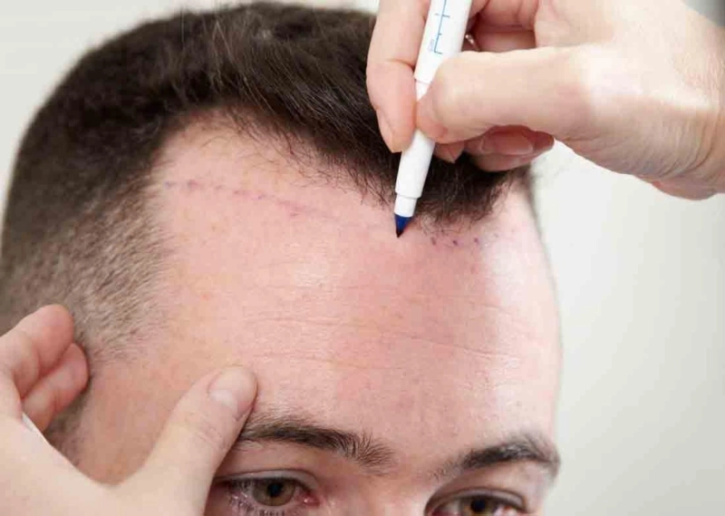 Hair Transplantation Vs Prosthetic Hair: Which One Is Better?