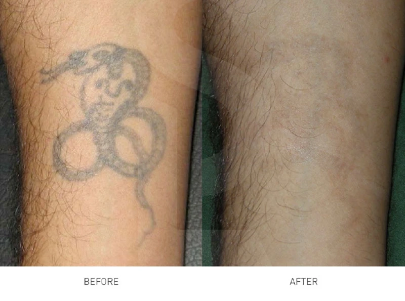 Methods for Tattoo removal New York