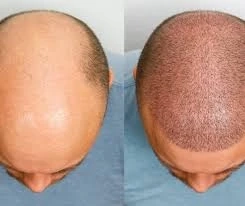 Unlocking the Secret to Successful Hair Transplants in Lahore's Summer Heat
