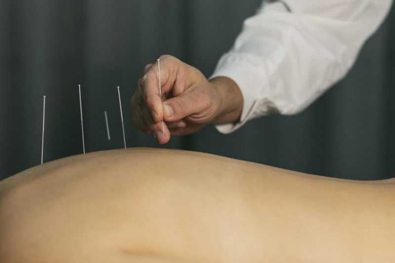 Ancient Needles, Modern Magic: Recharge with Cutting-Edge Acupuncture in Bowen Hills