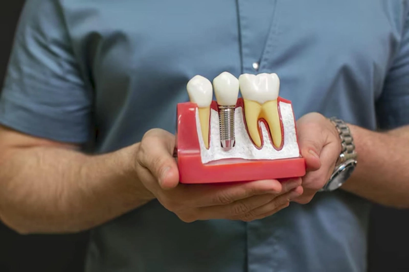Dental Implant Procedure: Step by Step Guide
