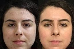 Expert Advice: 6 Common Melasma Treatment Mistakes in Dubai