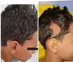 Hairline Lowering Surgery Cost Guide: What Determines Your Final Price in 2025