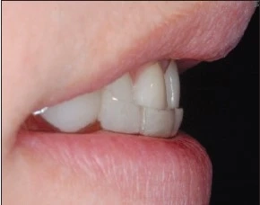 Dental Mouth Guards | Snö Dental Clinic in Abu Dhabi, UAE | Dental Clinic in Abu Dhabi , UAE