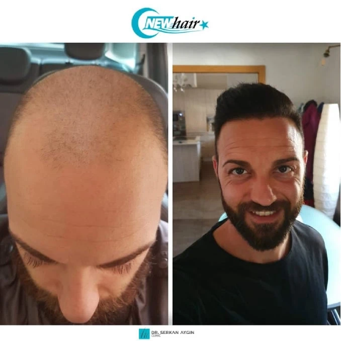 USE OF MINI AND MICROGRAFTS IN HAIR TRANSPLANT SURGERY