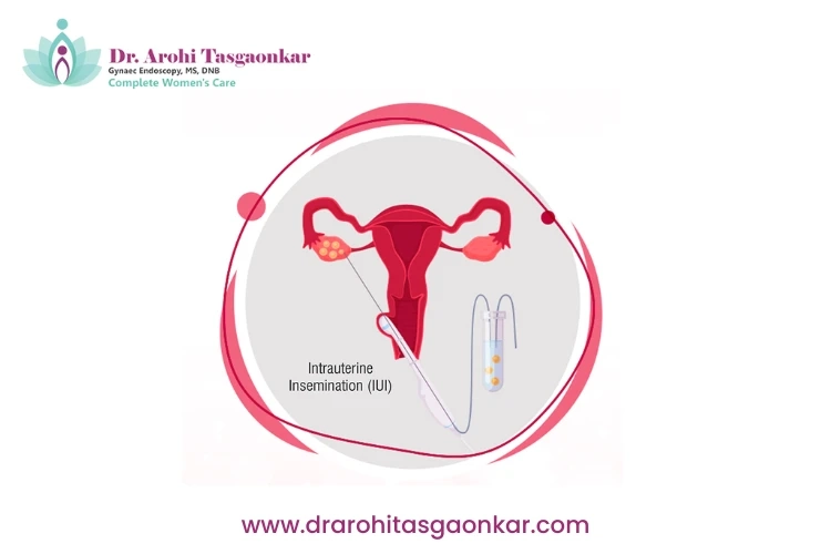 All You Need To Know About IUI treatment