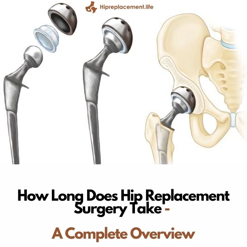 How Long Does Hip Replacement Surgery Take – A Complete Overview