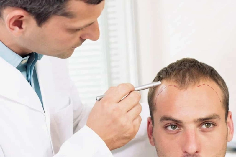 Things To Consider While Choosing Hair Transplant Surgeon in India