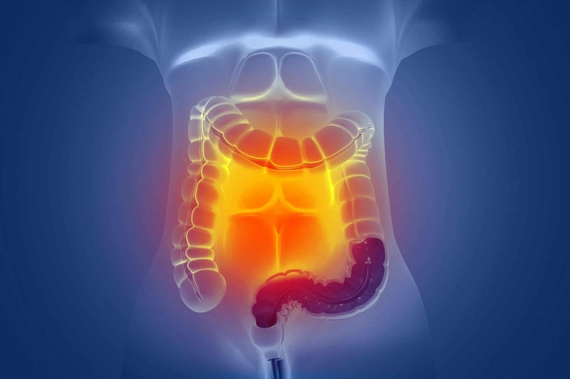 Unlocking Opportunities: Colorectal Cancer Market Entry Strategy Demystified