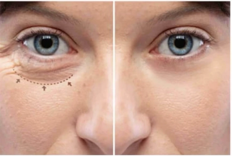 What age is good for eyelid surgery?