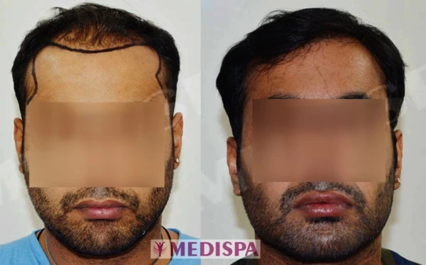 How To Get Permanent Solution For Hair Loss By Hair Transplantation?