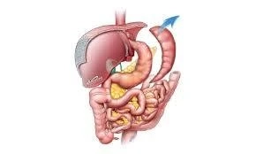 What Should Patients Know About Gastric Sleeve Revision Surgery?