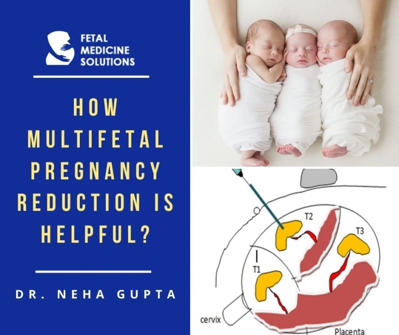 How Multifetal Pregnancy Reduction Is Helpful? Dr. Neha Gupta