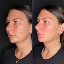 What to Know About a Thread Lift
