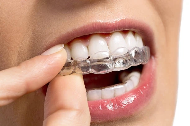 Invisible and Efficient: Clear Aligners for the Modern Professional