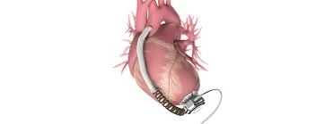 Ventricular Assistance Devices Market 2021 Key Players, Industry Size, Share, Segmentation, Comprehe