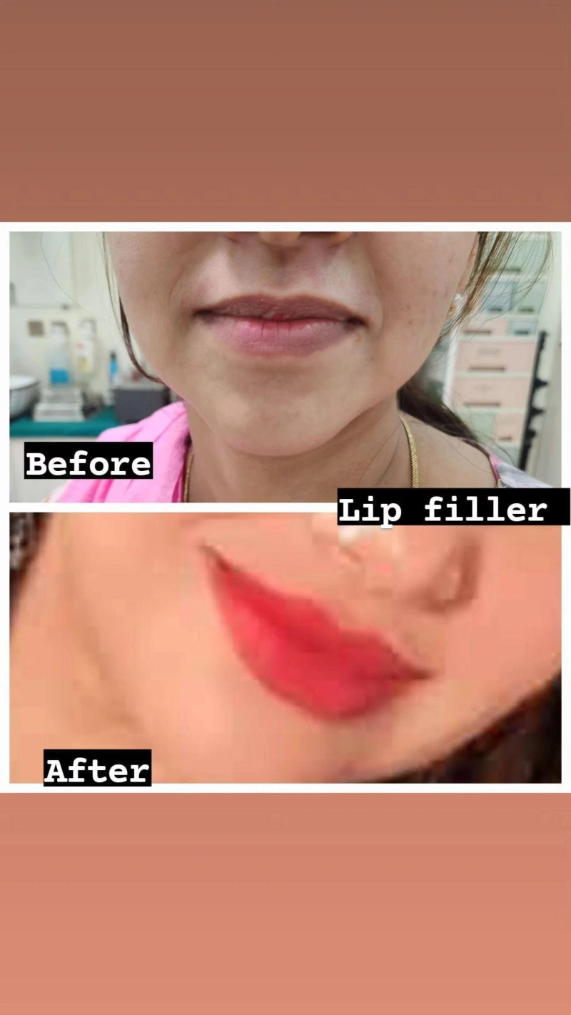 Enhance Your Look: Best Lip Filler Treatments at Aesthetic Clinics in Bhopal