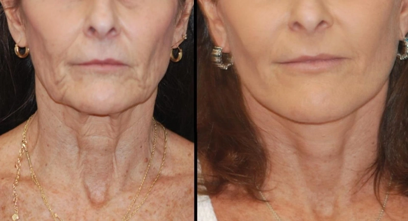 Deep Plane Facelift Explained: Technique, Benefits, and Recovery