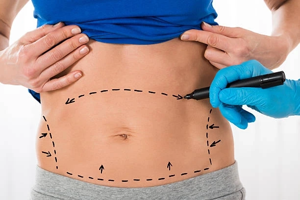 Mini Abdominoplasty: Your Riyadh Roadmap to a Flatter Stomach