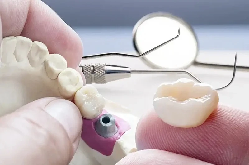 All You Need to Know About Dental Bridges