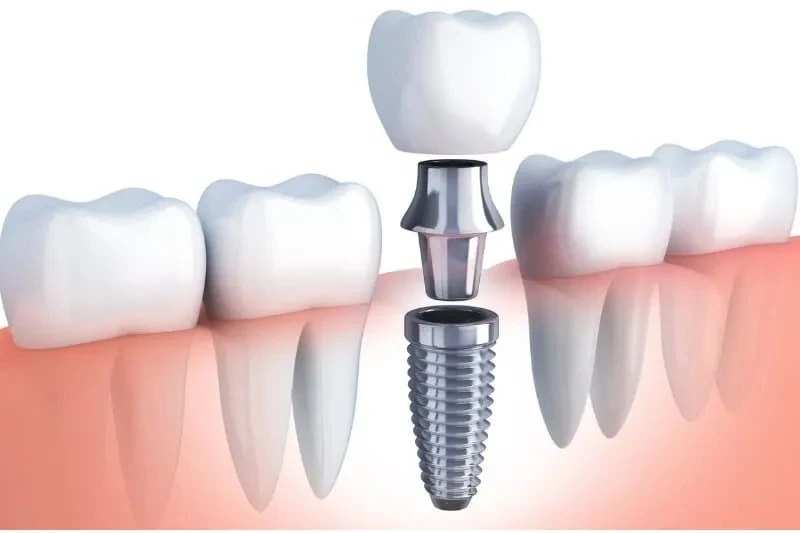 Enhancing Oral Health with Laser Periodontal Therapy in McKinney, TX