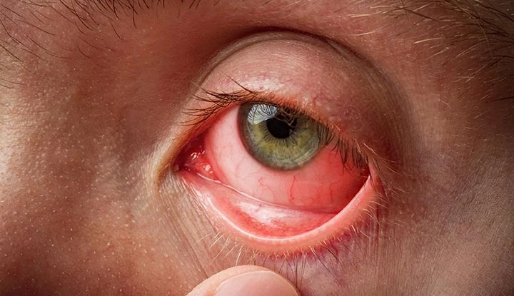 Natural Solution to the Pink Eye Problem