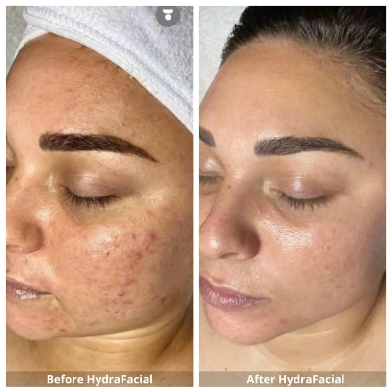 Trusted by Hundreds: HydraFacial in Peshawar