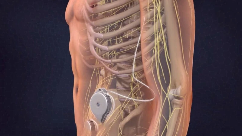 Direct Delivery Of Pain Medication To The Spine Using Intrathecal Pumps