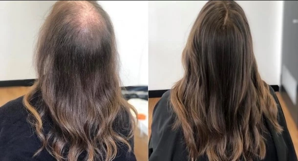 Exploring Various Hair Growth Treatment: Solutions for Every Need