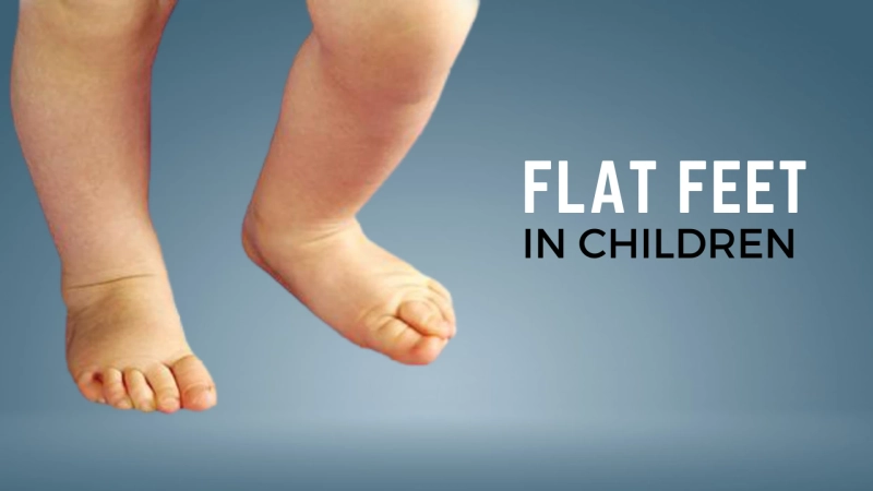Flat Feet in Children