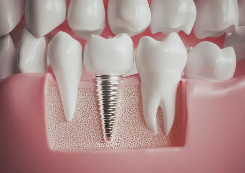 Rapid Restoration: Emergency Dental Implants in Preston