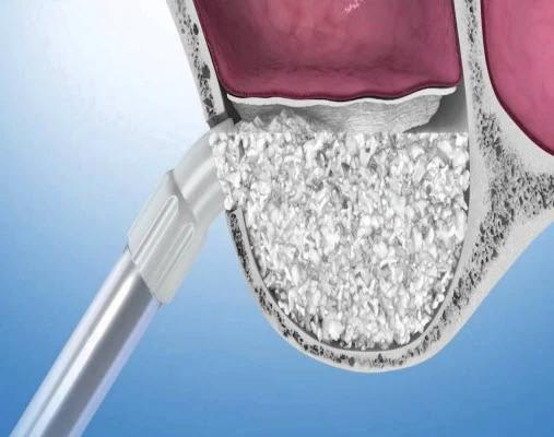 Maxillary Sinus Lifting in India: Balancing Quality and Affordability
