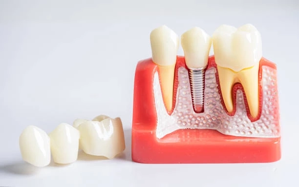Why Dental Implants Are the Gold Standard for Missing Teeth