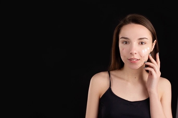 Common Treatments To Treat Freckles & Acne Scars
