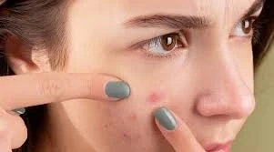 Glutathione Supplementation and Its Effects on Acne