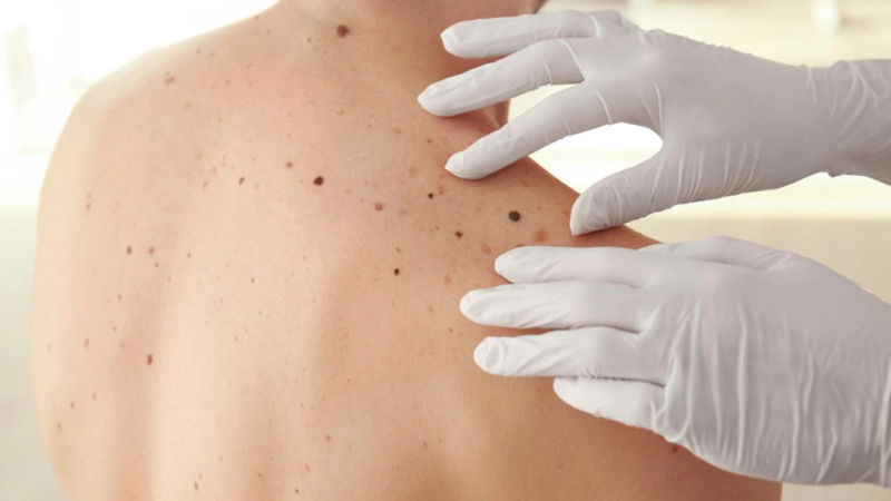 Skin Cancer Moles