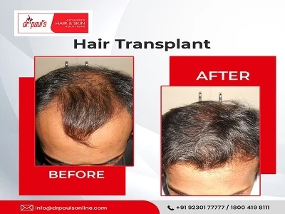 10 Unknown Benefits Of Hair Transplant In Kolkata