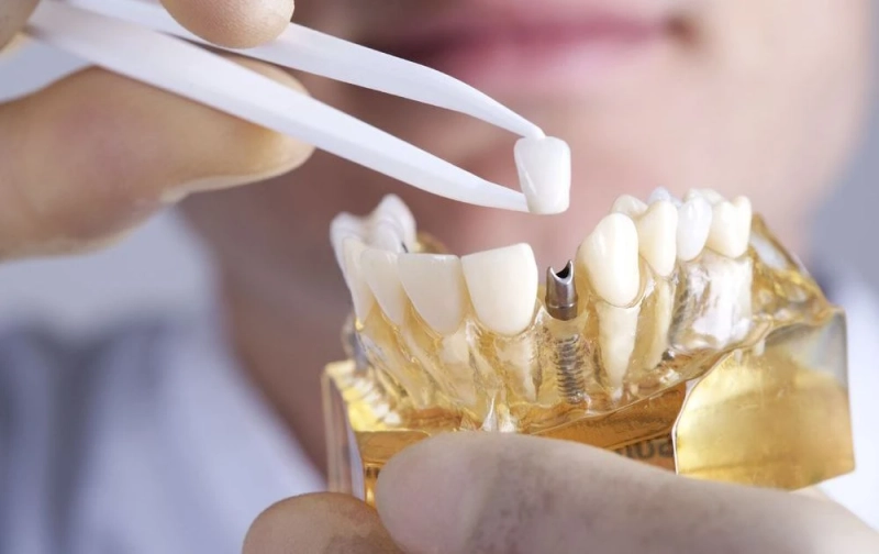 Budgetary Expenses on Dental Implants