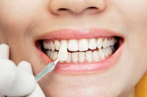 Accomplish That Hollywood Smile With Veneers In Dubai