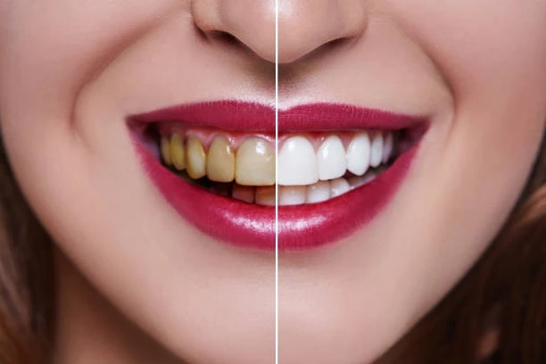 Teeth Whitening: Safe Options & What Works Best