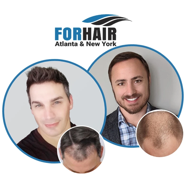 Why It Is Important To Check Patient Success Stories: Before And After Hair Transplants